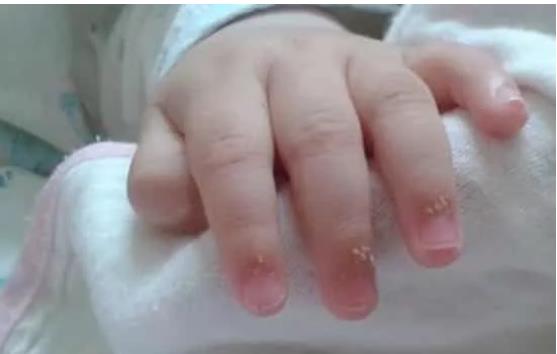 解惑答疑丨寶寶手指長倒刺是因?yàn)槿狈S生素嗎？