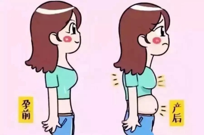 產后大肚腩，小心是腹直肌分離在作怪