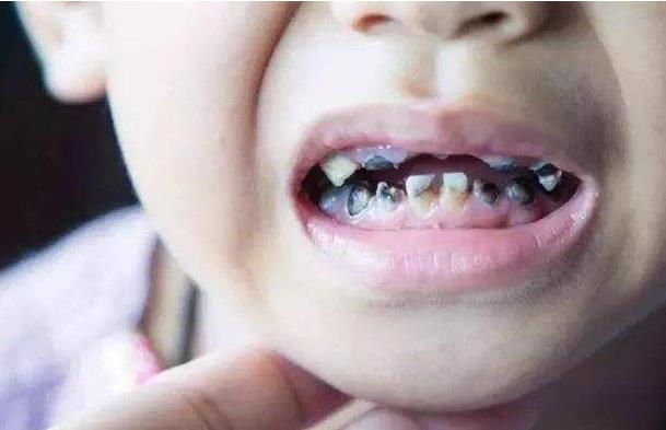 孩子滿口"黑牙"不一定是因為是糖果！