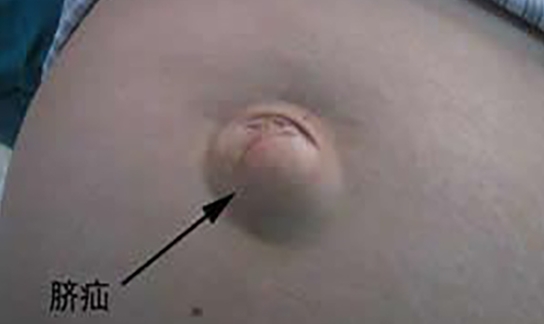 用硬幣壓肚臍可以治療臍疝么？千萬別盲目