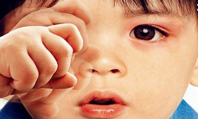 小孩頻繁揉眼，小心兒童過敏性結(jié)膜炎來襲