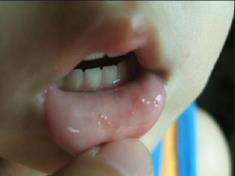 寶寶手足口病從4月開始謹(jǐn)慎預(yù)防 了解護理妙招