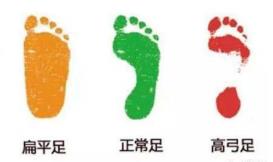 扁平足是有機(jī)會矯正的 你給孩子買對鞋了嗎