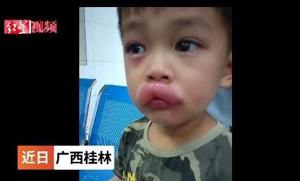 男孩吃葡萄過敏腫成嘟嘟嘴 現(xiàn)實(shí)版香腸嘴看著讓人心疼不已
