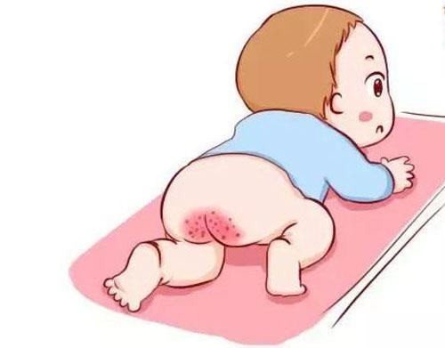 面對(duì)寶寶紅屁股，媽媽需要注意這幾件事
