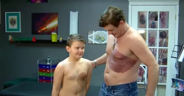 加拿大爸爸忍痛紋胎記，助力兒子擺脫自卑