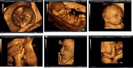 孕檢必須要做四維嗎？結(jié)果可能讓你想不到