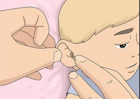 5歲女孩聽(tīng)力下降，醫(yī)生檢查發(fā)現(xiàn)耳屎堵滿了耳道