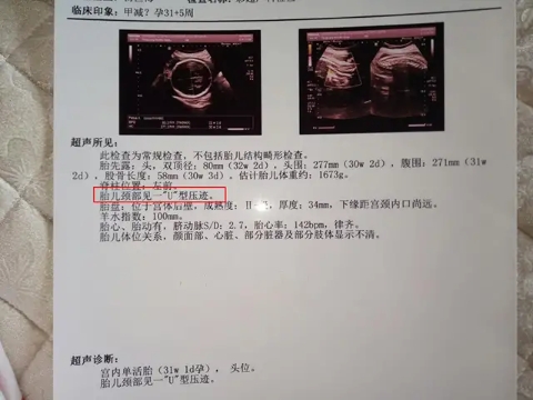 孕媽要注意了，你的這些習慣可能讓胎兒臍帶繞頸