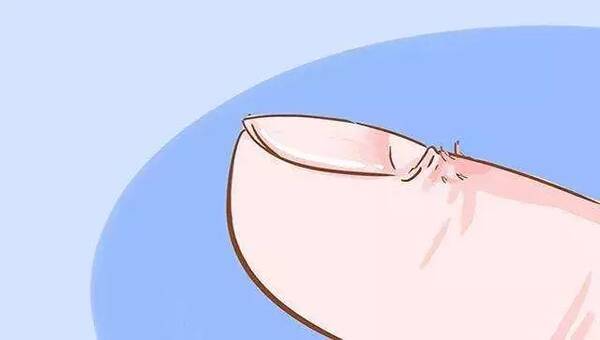 孩子手上長倒刺是缺鋅？真正的癥狀在這里，家長別大意