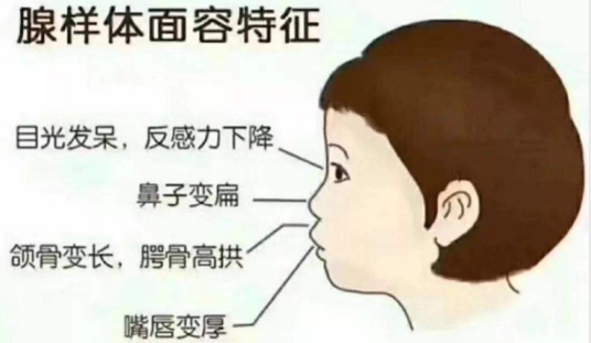 不可小覷的兒童常見病—腺樣體肥大