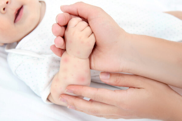 兒童過(guò)敏怎么辦？謹(jǐn)記三招，應(yīng)對(duì)孩子過(guò)敏