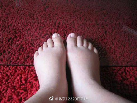 孕期生理性水腫需要治療嗎？