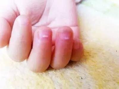 孩子上手的倒刺可能是身體在“求救”，家長千萬要注意