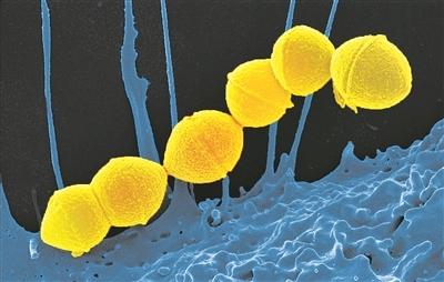 “食人菌”真的會“吃人”？